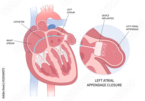 Left arterial appendage closure device implant to heart for treatment atrial fibrillation