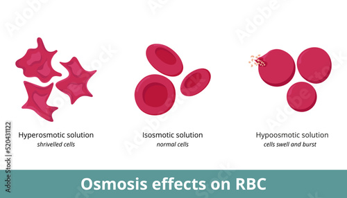 Osmosis effect on red blood cells. Depending on solution concentration (hyperosmotic, isosmotic, or hypoosmotic), erythrocytes can shrivel or swell and burst.