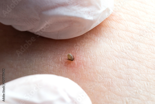 Sucking tick Macro photo on human skin. Ixodes ricinus. Bloated parasite bitten into pink irritated epidermis. Small red drops. Dangerous insect mite. Encephalitis, Lyme disease infection