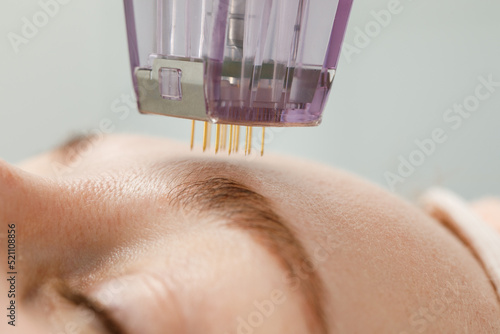 Microneedle mesotherapy. Woman receiving micro needling rejuvenation treatment in a cosmetology clinic.