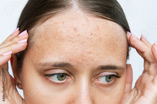 Cropped shot of young woman's face with acne problem, red allergic rash on a forehead. Allergies, pimples, hormonal changes. Problem skin, care and beauty concept. Dermatology, cosmetology