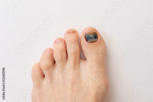 Subungual hematoma present under the toenail of the hallux, more commonly known as the big toe. broken toenail is when blood forms under a fingernail or toenail. Blue black toenail.