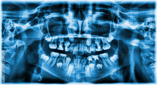 different types of wisdom teeth problems concept. Problem teeth X-ray image scanned