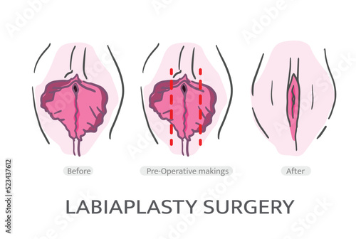 LABIAPLASTY surgery TECHNIQUES. Labiaplasty Vector. Types of female labia