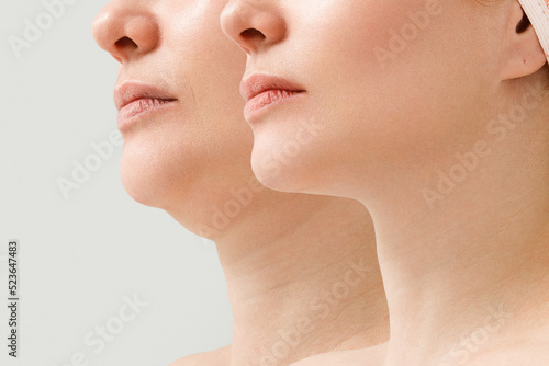 A close portrait of an aged woman before and after the facelift procedure. The result of facial rejuvenation and wrinkle smoothing in a cosmetology clinic.