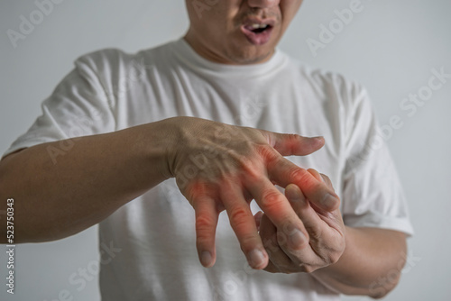 Man hand suffering from joint pain with gout in finger. cause of pain include rheumatoid arthritis, carpal tunnel syndrome, trigger finger or gout. health care and medical concept.