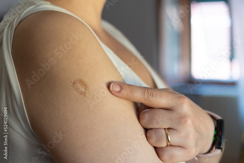 Monkeypox and smallpox vaccine concept: woman shows smallpox vaccine scar on her arm