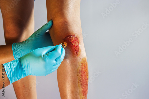 Close-up cleaning bleeding wound of knee after accident