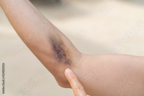 A bruise on forearm with the color of blue and purple is a hematoma of tissue with the background of blurred sand.