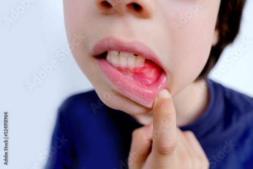 closeup part of boy of 10 years old opened his mouth, oral cavity, close-up teeth reddened gums, concept pediatric dentistry, dental treatment, correction of occlusion, oral care, caries prevention