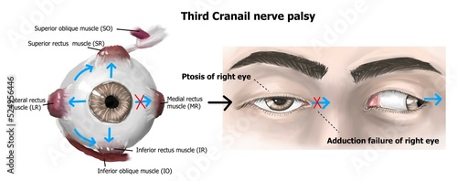 The clinical presentation of right third cranial nerve palsy.