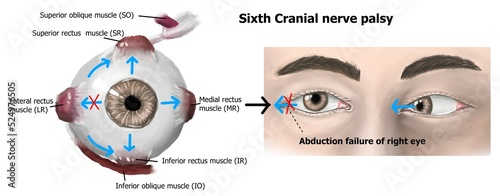 the clinical presentation of right sixth cranial nerve palsy.