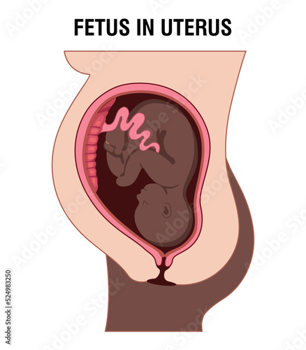Placental previa. Fetus in Uterus During Pregnancy. Pregnancy women anatomy. Fetus with umbilical cord and placenta. Usual anatomical Placenta Location. Detailed medical vector illustration. 