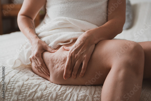 Close-up of female body with cellulite, woman makes massage against cellulite with her hands.