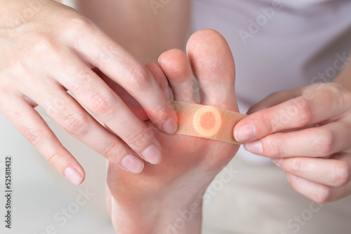 Woman sticks a medical plaster to the plantar wart of the leg to remove dead skin and calluses, close-up