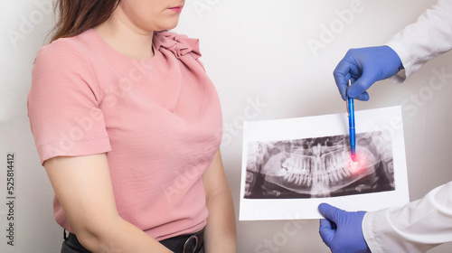 The doctor holds a panoramic X-ray picture of the patient s teeth with a sick semi-urethinal wisdom tooth. Wisdom teeth extraction concept in dentistry