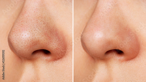 Close-up of woman's nose with blackheads before and after peeling and cleansing the face. Acne problem, comedones. Getting rid of black dots. Cosmetology dermatology concept