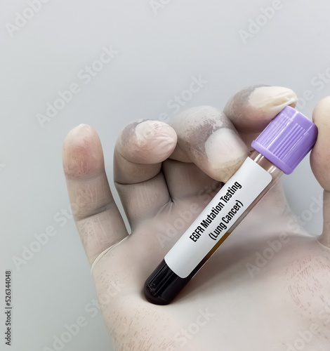 Molecular biologist holding blood sample for EGFR mutation test for the diagnosis of lung disease. Epidermal Growth Factor Receptor.