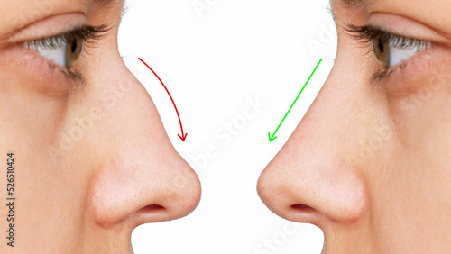 A profile of woman's face with nose before and after rhinoplasty isolated on white background. Comparison after cosmetic plastic surgery on the hump of the female nose. Correction of the nasal septum