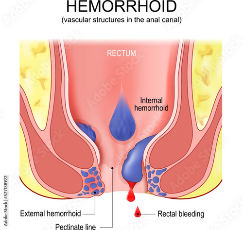 piles. hemorrhoids. Cross section of the rectum and anal canal