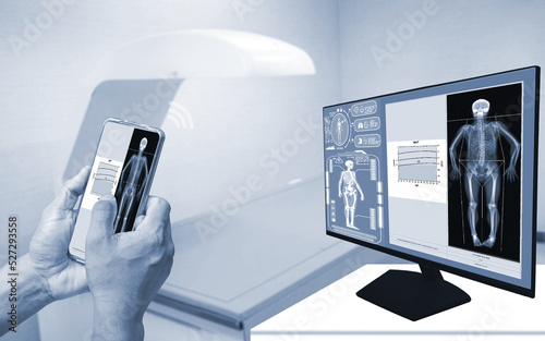 Close-up Doctor uses a smartphone to check an Image of a DXA bone density scan on a monitor in a woman to prevent osteoporosis. blurry bone densitometer machine background.Medical technology concept.