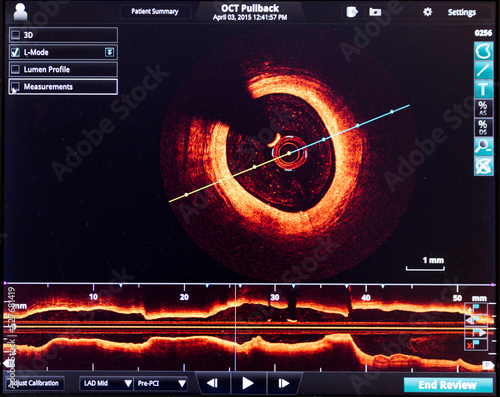 Intravascular optical coherence tomography oct image angiography catheter lab atherosclerosis. measurement of coronary artery in cross-sectional and longitudinal view. during cardiac catheterization.