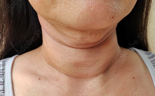 close up of a woman showing the flabbiness adipose sagging skin under the neck, wrinkles and flabby skin, problem cellulite and rough skin under the chin of the woman, concept health care.