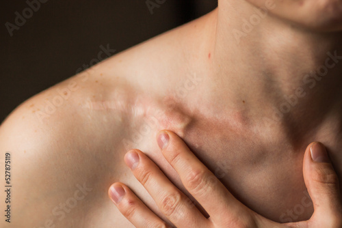 Close-up of man's collarbone injury. Black background. Injured athlete after successful fractured clavicle bone surgery.