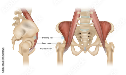 Internal snapping hip Syndrome. Psoas major, Iliopsoas muscle and Snapping area. Vector