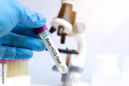 Urine samples for testing HCG in the laboratory