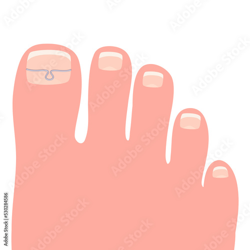 Toes on the right foot with a titanium staple on the thumb for correction of the shape of the toenail cartoon vector illustration isolated on a white background