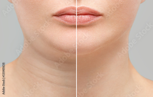 Female double chin before and after correction. Correction of the chin shape liposuction of the neck. The result of the procedure in the clinic of aesthetic medicine.