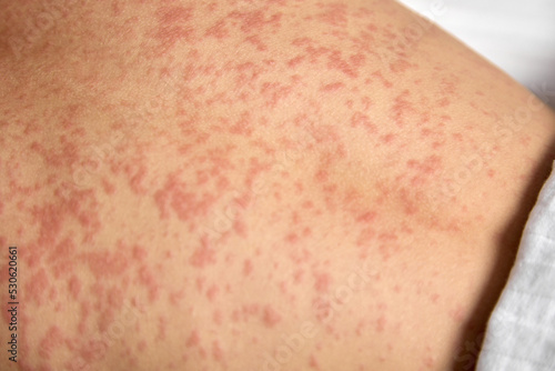 Close-up of a red rash on the human body. Human skin is covered with painful red spots