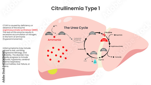 Citrullinemia Type 1 ASS1 Deficiency informational vector