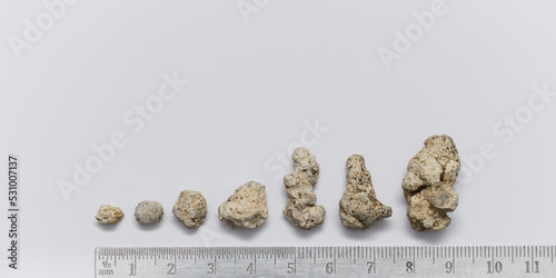 Kidney stones in different shapes from small to large.the concept of timely kidney treatment.