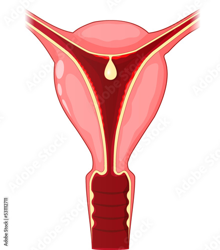 Uterine polyp. Human uterus with Endometrial polyp
