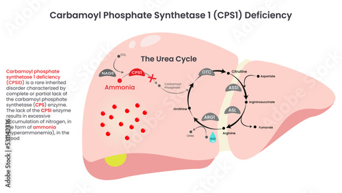 Carbamoyl Phosphate Synthetase (CPS1) Deficiency vector illustration