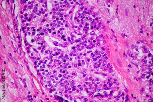 neuroendocrine tumor 