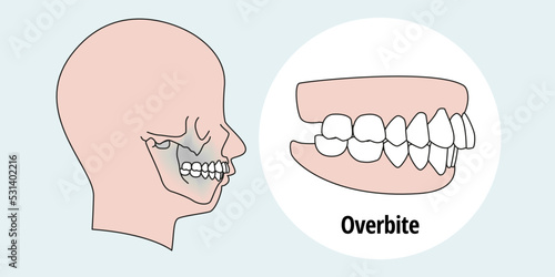 Side view of man after orthodontic treatment, right teeth aligned