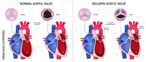 The difference of normal aortic valve and bicuspid aortic valve. Valvular aortic stenosis. Heart anatomy vector. Close-up of normal and abnormal aortic valves.