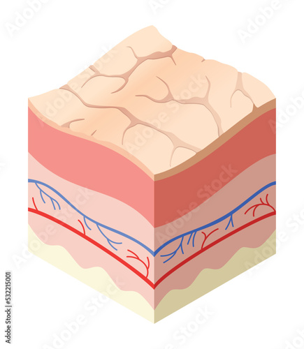Skincare medical concept. Problems in cross-section of human skin horizontal layers structure. Anatomy illustrative model unhealthly layer of skin