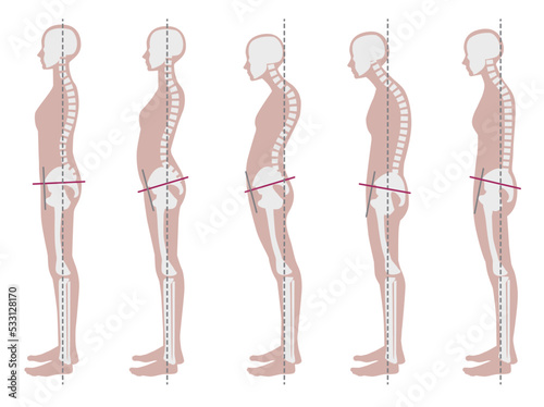良い姿勢と悪い姿勢の骨格見本
