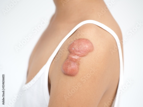 Keloid scar of skin shoulder kid girl case of tissue forms over the wound to repair treatment of laser to reduce size. 