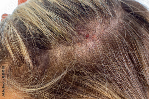  Psoriasis of the scalp , psoriatic redness, peeling and crusts on the scalp of an unrecognizable woman. An autoimmune, incurable dermatological skin disease.