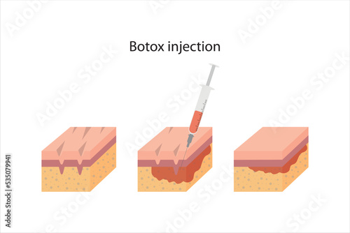 Vector illustration of botox injection