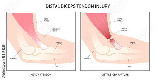 distal bicep tendonitis rotator cuff pain upper arm inflamed