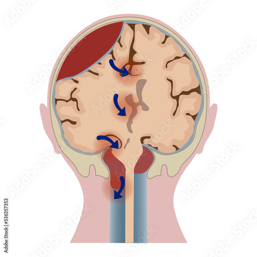 Brain hematoma with tissue distortion. Sectioned head. Medical poster. Vector illustration