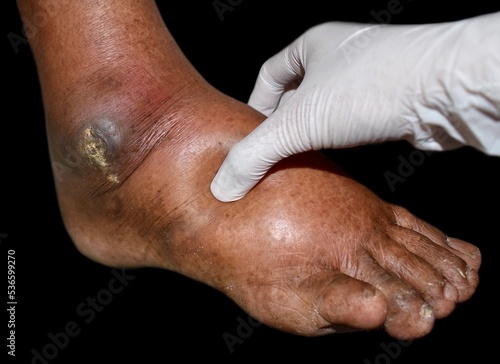 Pitting edema of lower limb. Swollen leg of Asian man.