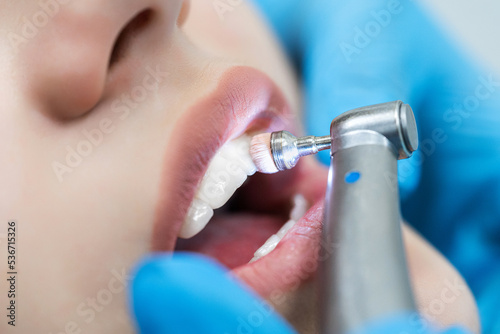 Close-up of teeth with brushing technology in the dentist's office. Dentistry and cleaning and whitening procedure.