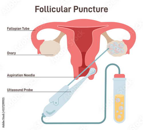 IVF. Follicular puncture, removing oocyte from the ovary of a woman